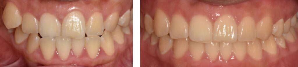 crooked teeth painless treatment in treatment
