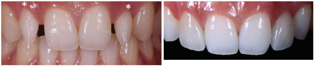 Boston Veneer dentist