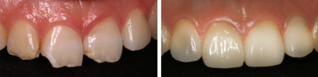 boston veneer treatment