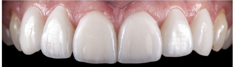 Veneers