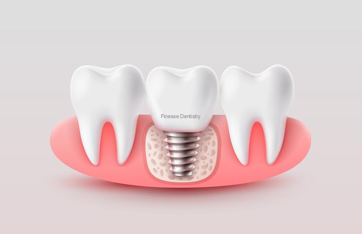 Everything You Need to Know About a Single-Tooth Dental Implant