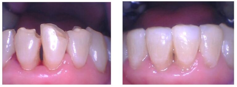 Biomimetic Dentistry (Conservative Composites/Bondings)