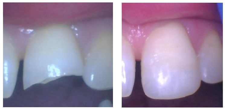 Composites_Front_Teeth2